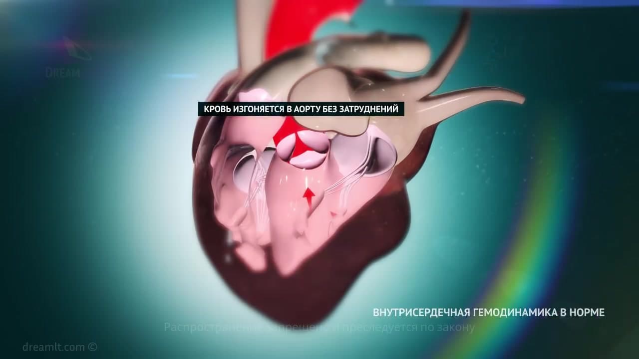 Стеноз аортального клапана - этиология, патогенез, клинические проявления и физикальные данные