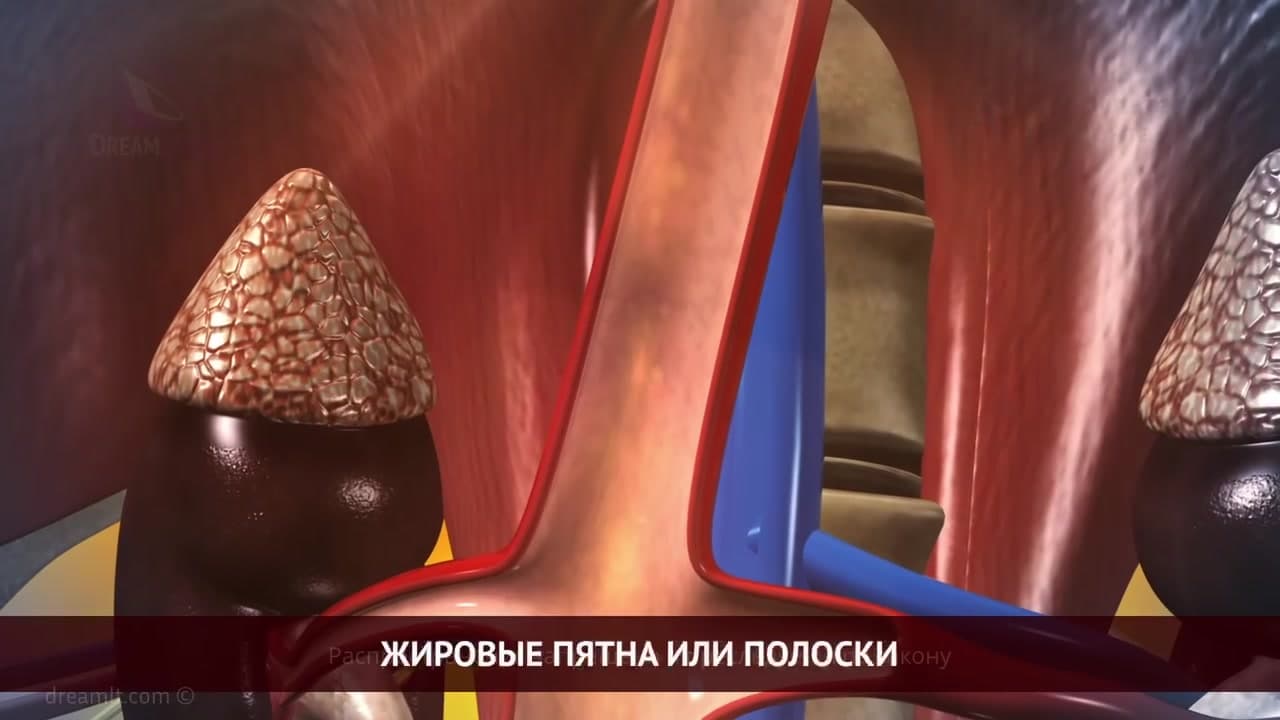 Атеросклероз