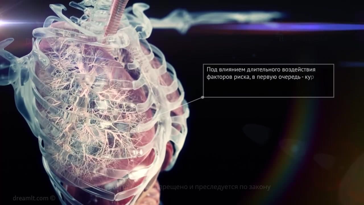 Патогенез ХОБЛ