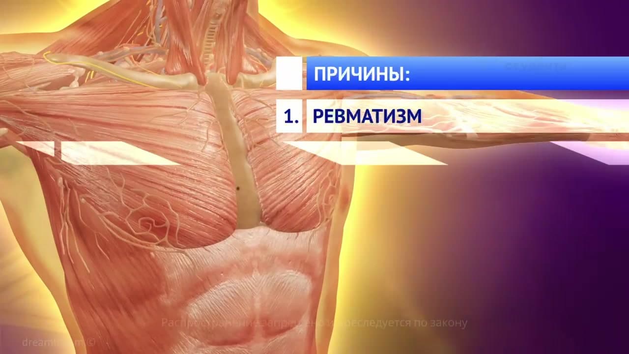 Пороки сердца