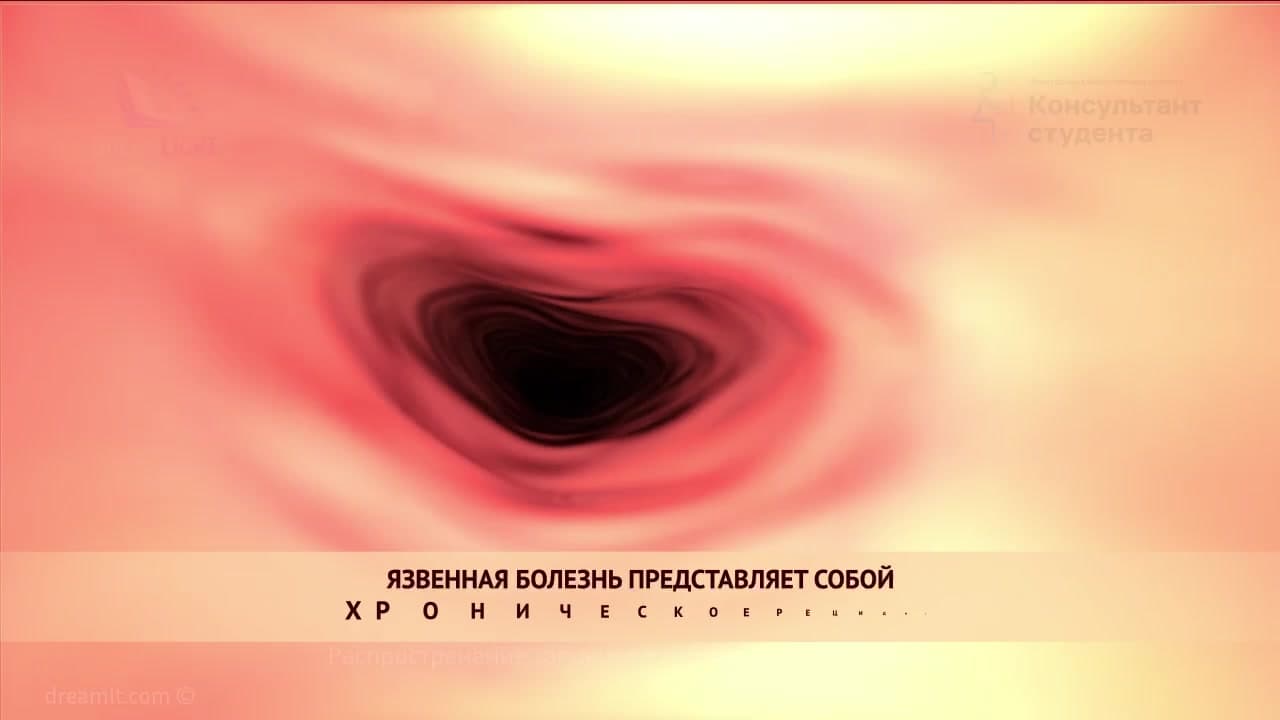 Роль helicobacter pylori в образовании язвы желудка