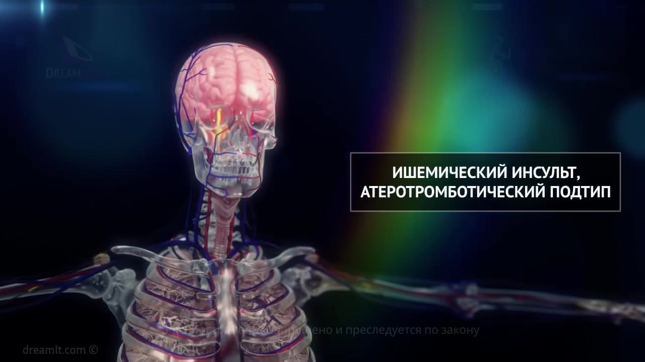 Патогенез ишемического инсульта