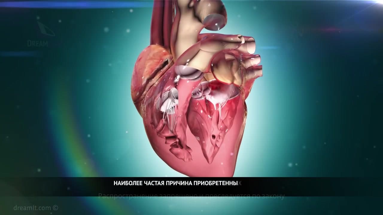 Митральный стеноз - этиология, патогенез, клинические проявления и физикальные данные