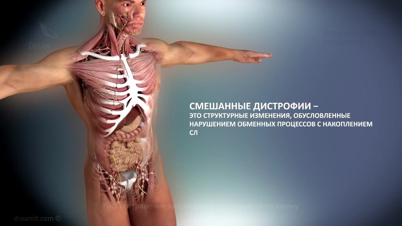 Смешанные дистрофии