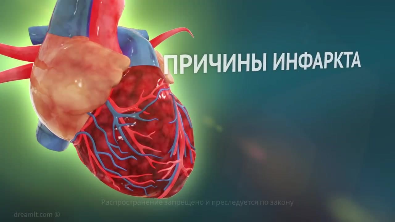 Инфаркт миокарда