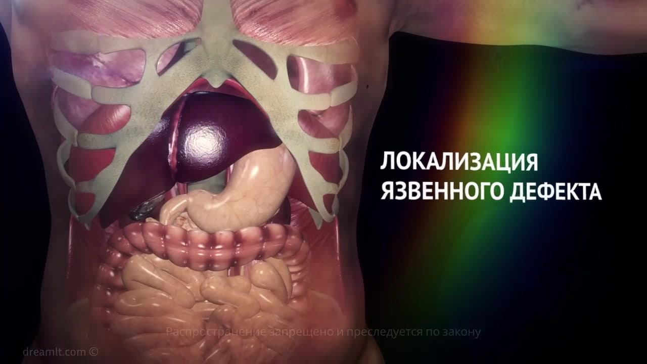 Язвенная болезнь