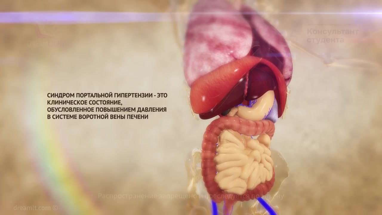 Синдром портальной гипертензии при циррозе печени