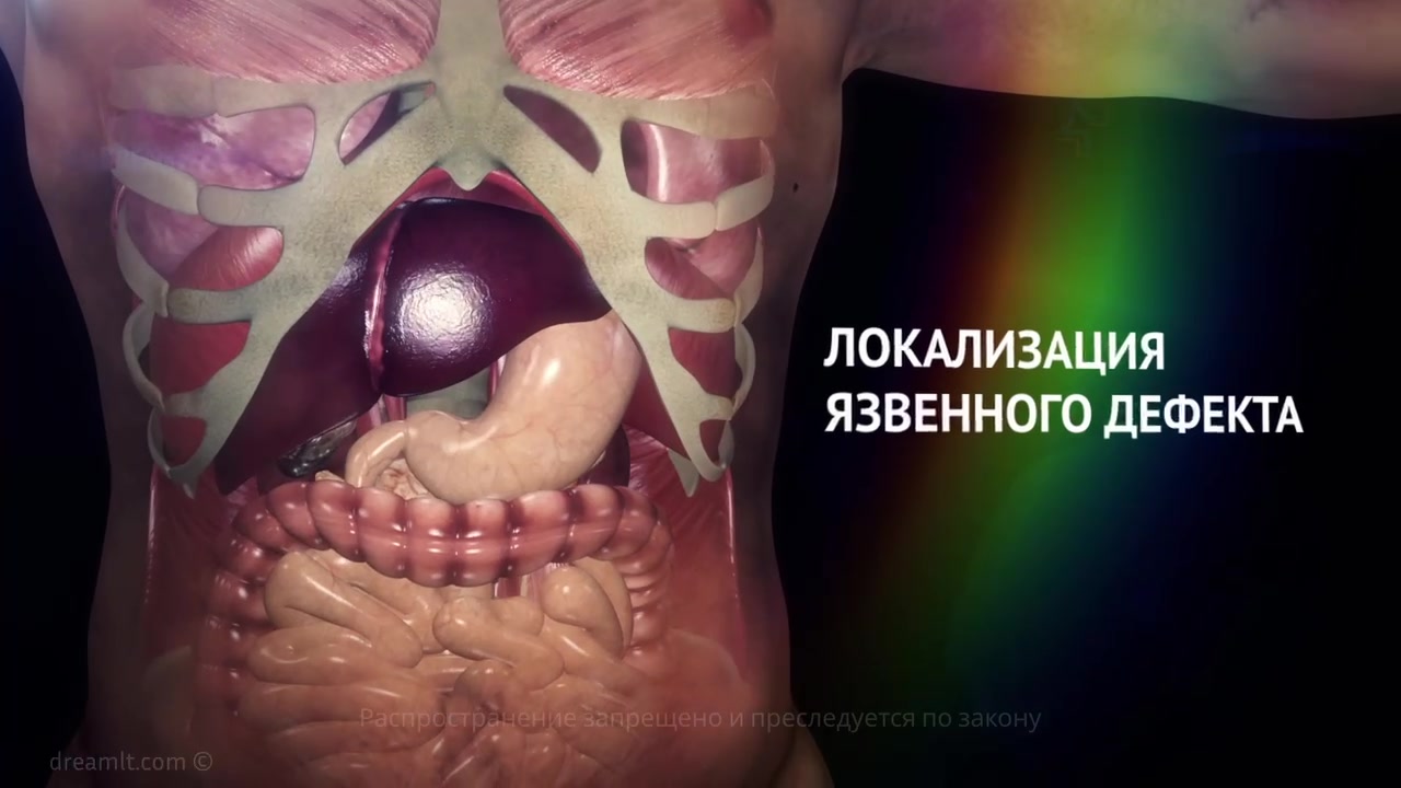 Язвенная болезнь